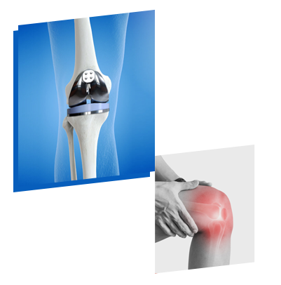 Knee Replacement Surgery